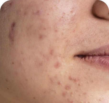 Pele com acne em avaliação
