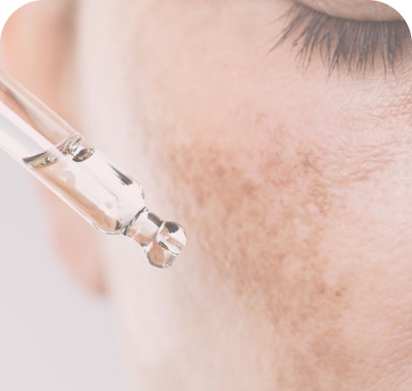 Pele com melasma em tratamento