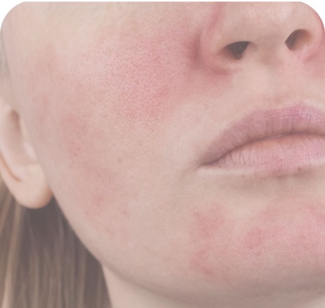 Pele sensibilizada em avaliação dermatológica