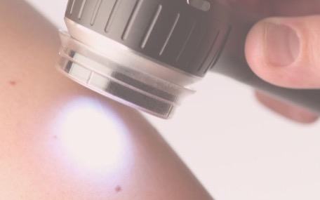 Exame de pinta na pele com dermatoscópio