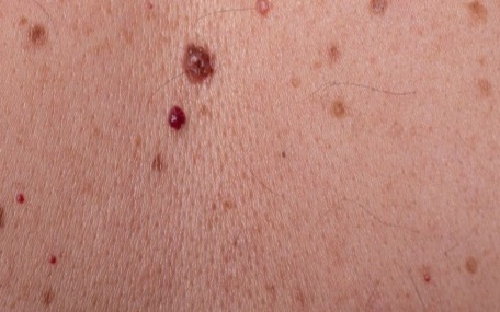 Pintas na pele em avaliação dermatológica